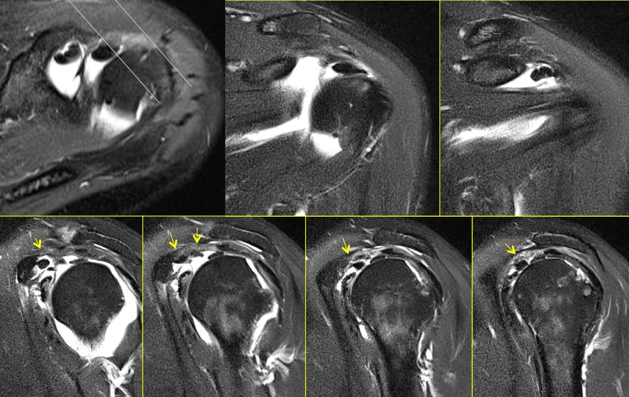 Figure 4 for case MDI and hypertrophy CHL